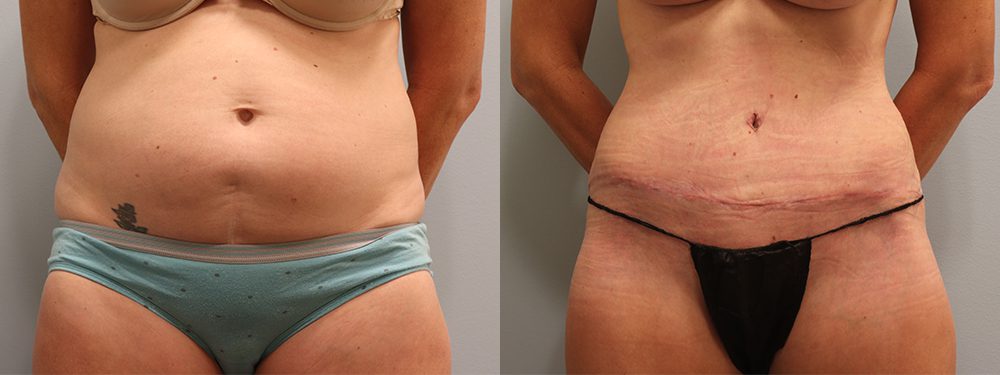 6 Before and After Tummy Tuck Photos That Will Make You Want One Yourself