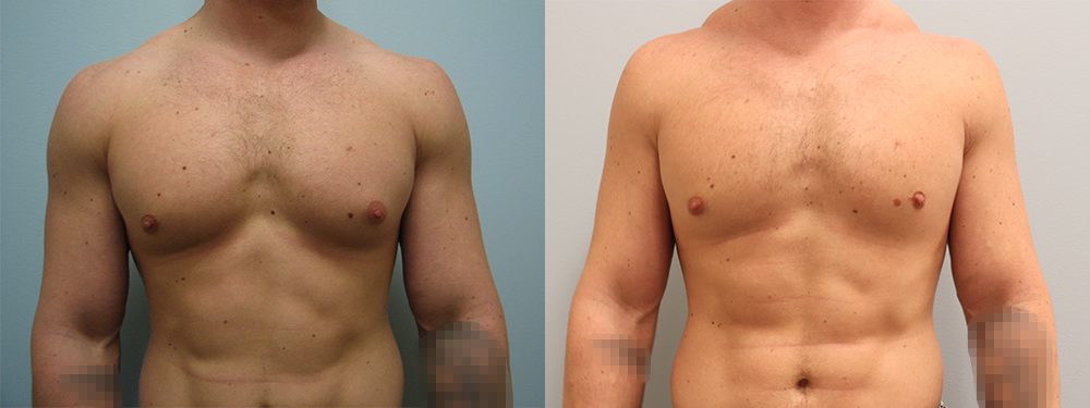 Gynecomastia Before & Afters, Omaha