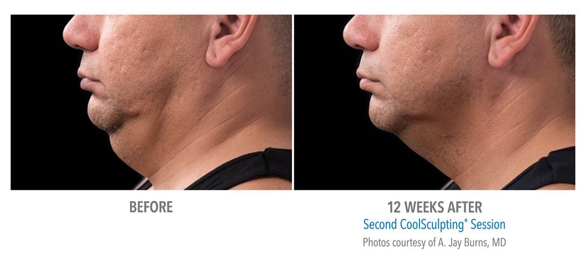CoolSculpting® Before and After 12 Weeks Comparison | Westfield Plastic Surgery Center ba burns sm pt008m 2set 18wk2 left