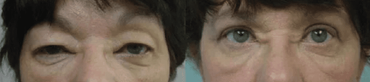 Blepharoplasty Before and After Photo
