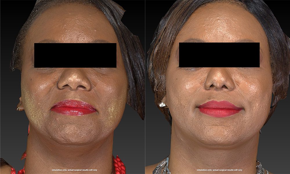 Rhinoplasty Before and After