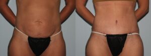 westfield ayoub Tummy Tuck