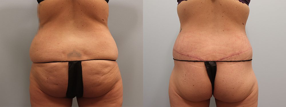 Body Lift Before & Afters, Omaha