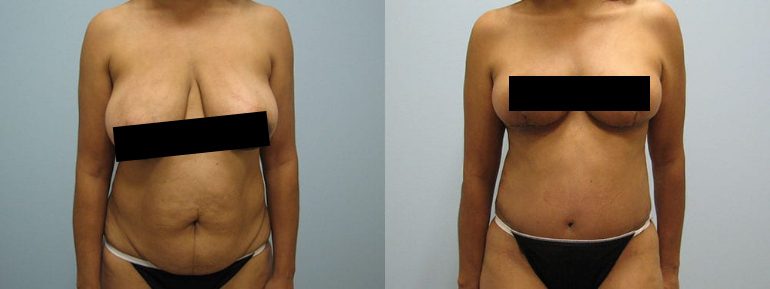 Mommy Makeover Patient Before  After