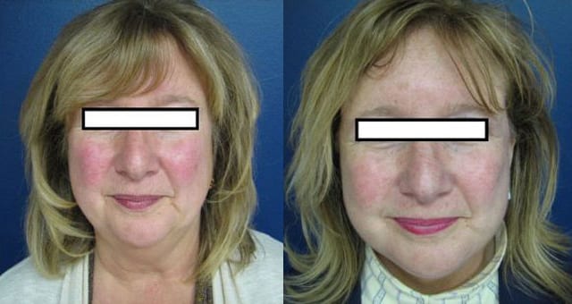 Facelift Before  After Widget