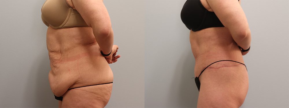 Body Lift Before & After Gallery: Patient 7