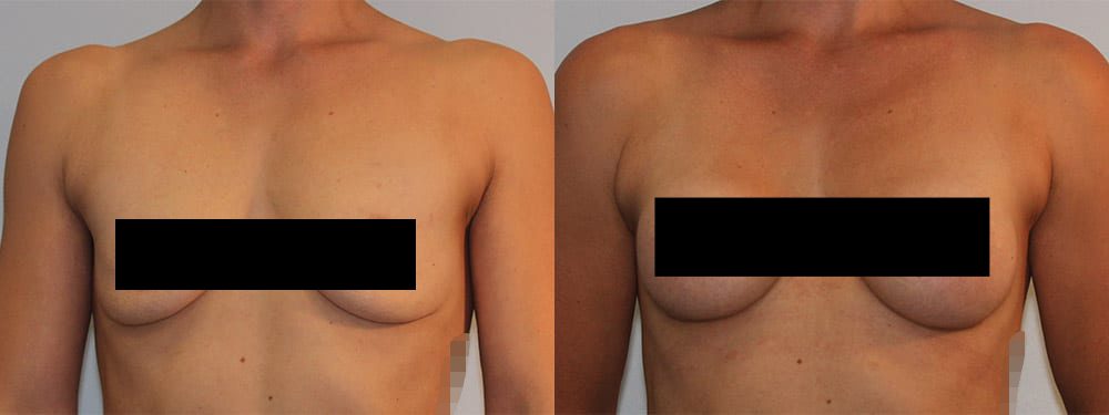 Breast Augmentation Before  After