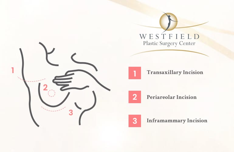 Graphic Depicting Types of Incisions