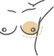 Low Breast Implant Profile