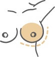 High Breast Implant Profile
